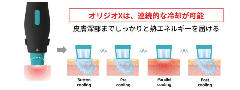 痛み、ダウンタイムを軽減したオリジオX（OligioX）