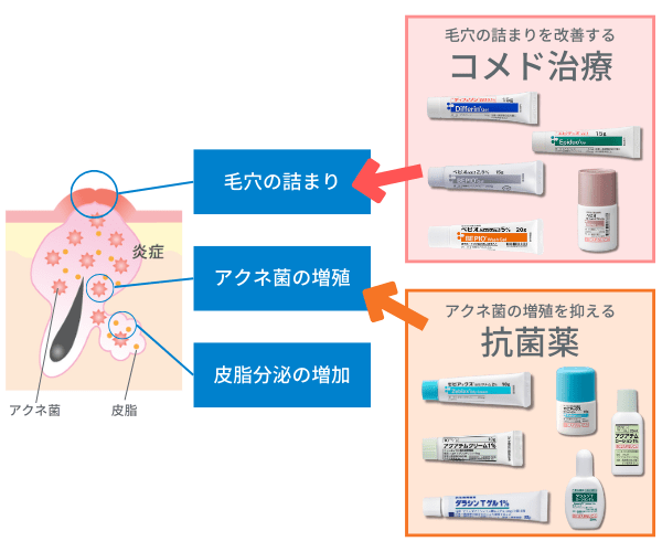 ニキビ治療の重要ポイント