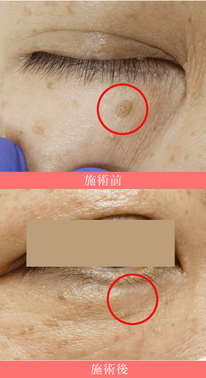 老人性イボ(脂漏性角化症)の当院症例(50代女性):右下眼瞼