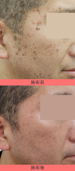 老人性イボ(脂漏性角化症)の当院症例(50代男性)2