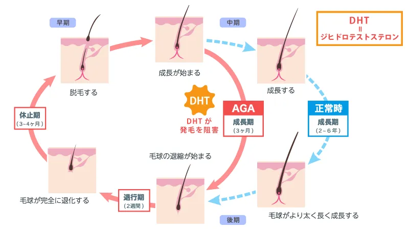 壮年性脱毛症（男性型脱毛症）