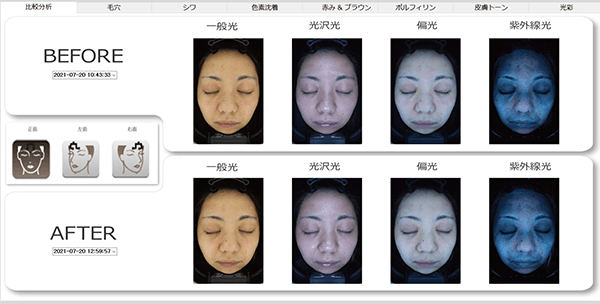 NeoVoir Ⅰ PLUS（ネオヴォワールワンプラス）：治療前後のデータ比較が可能