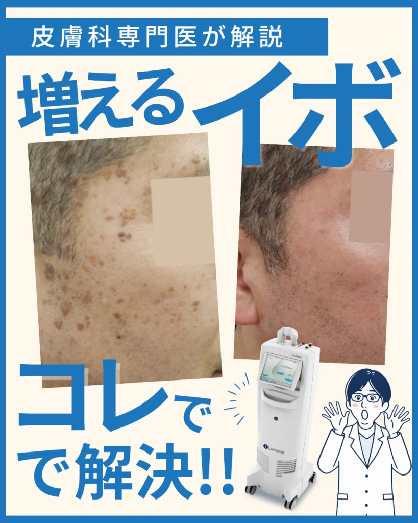 増えるイボ（脂漏性角化症）の原因と治療法