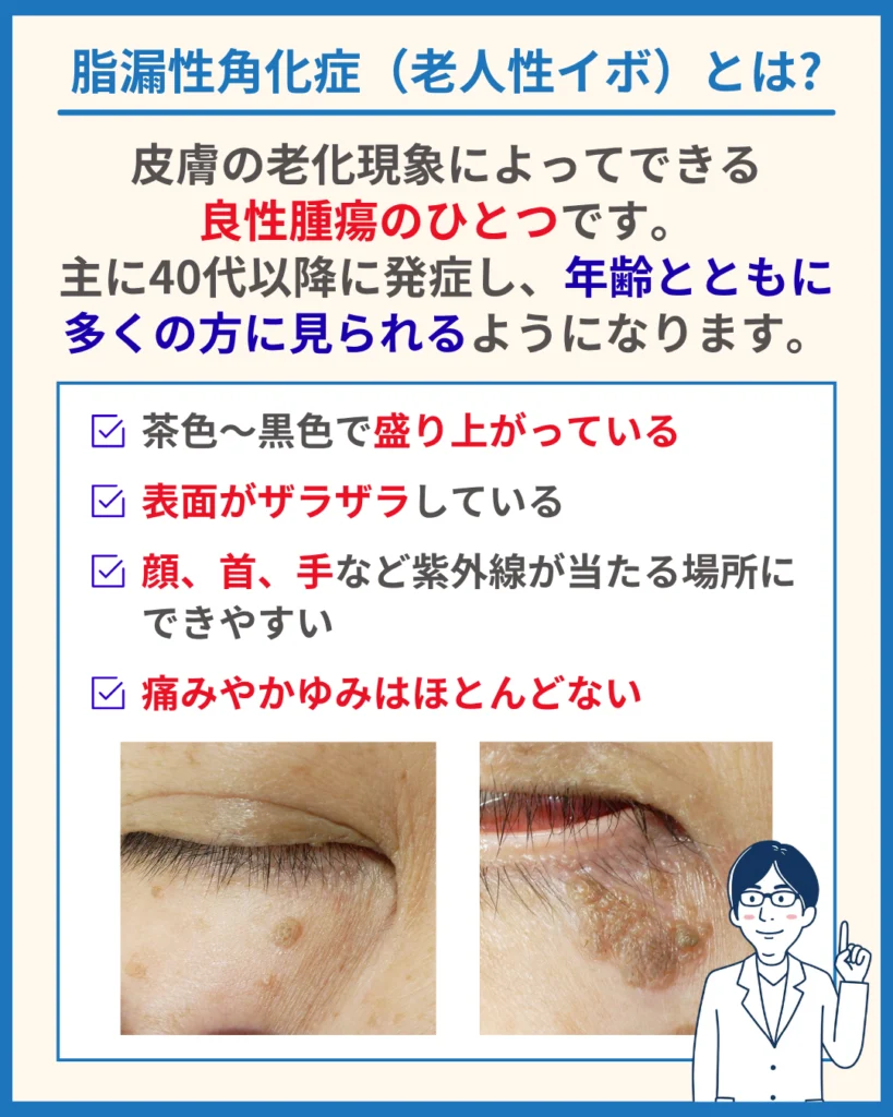 脂漏性角化症（老人性イボ）とは