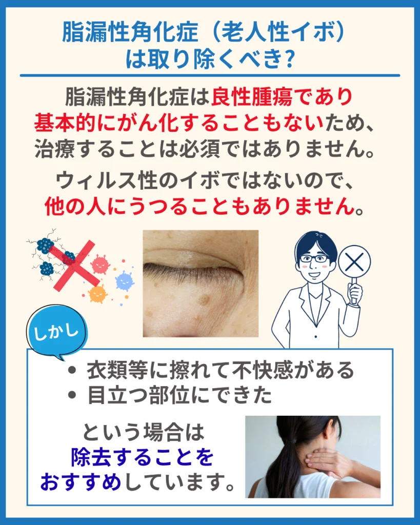 脂漏性角化症（老人性イボ）は取り除くべき?