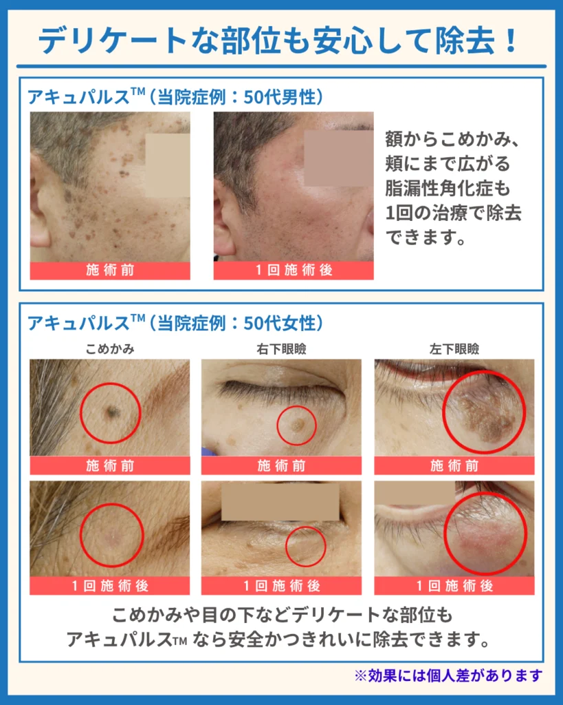 「AcuPulse™（アキュパルス）」による当院症例