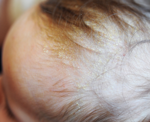 乳児脂漏性皮膚炎(にゅうじしろうせいひふえん)とは