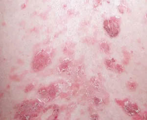 水疱症の症状:落葉状天疱瘡