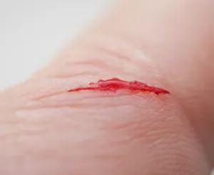 切り傷・けが(切創・外傷)の症状:出血や痛み