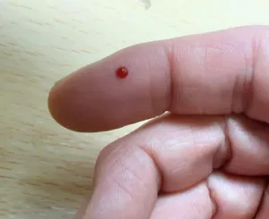 切り傷・けが(切創・外傷)の症状:小さく深い刺し傷(刺創)
