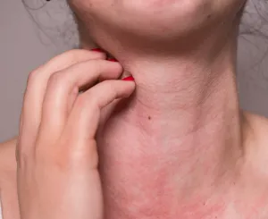 アトピー性皮膚炎・接触皮膚炎(かぶれ)がある方が切り傷・けがをした場合の注意点