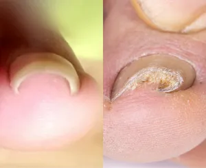 巻き爪の症状
