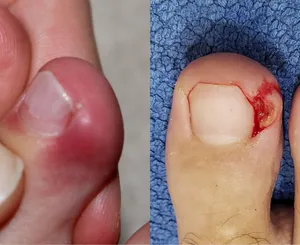 陥入爪の症状