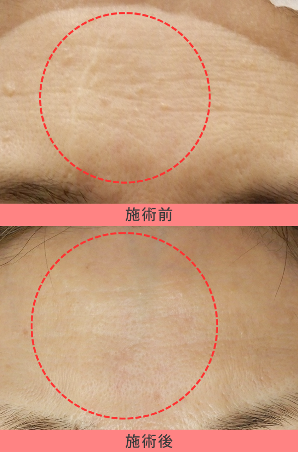 稗粒腫の当院症例①