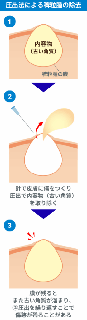 圧出法による稗粒腫の除去