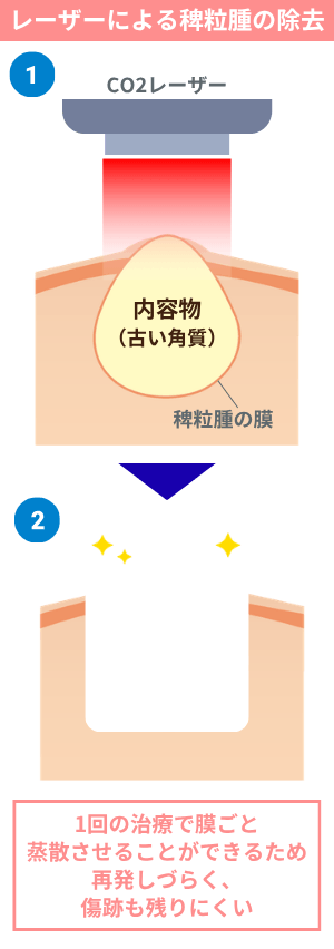 炭酸ガスレーザーによる稗粒腫の除去