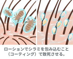 アタマジラミの治療:ジメチコン製剤(シラミとりローションなど:医薬部外品)